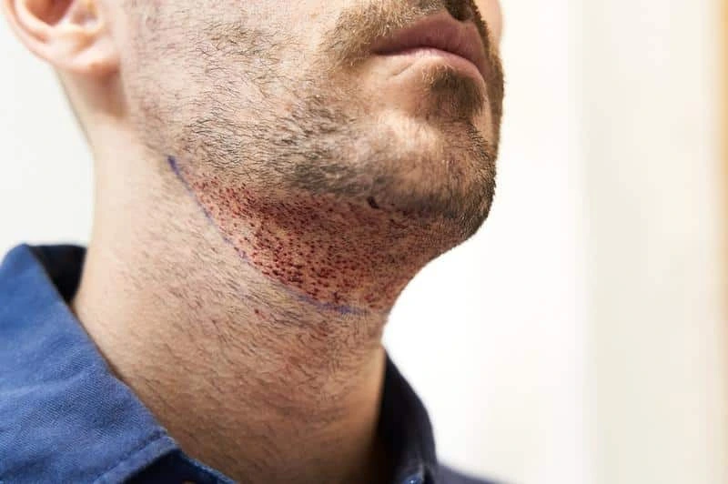 Patient 1 dag efter en skäggtransplantation.