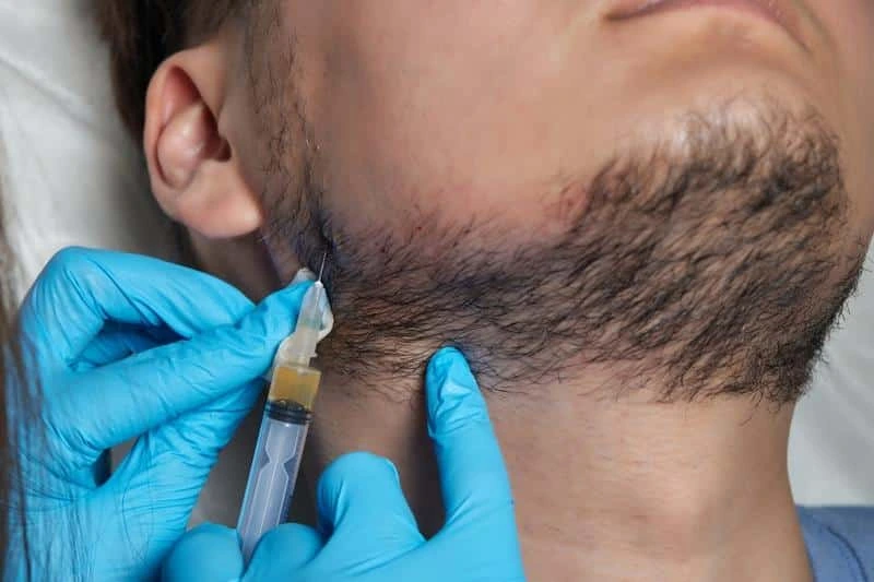Läkare förbereder patient inför skäggtransplantation.