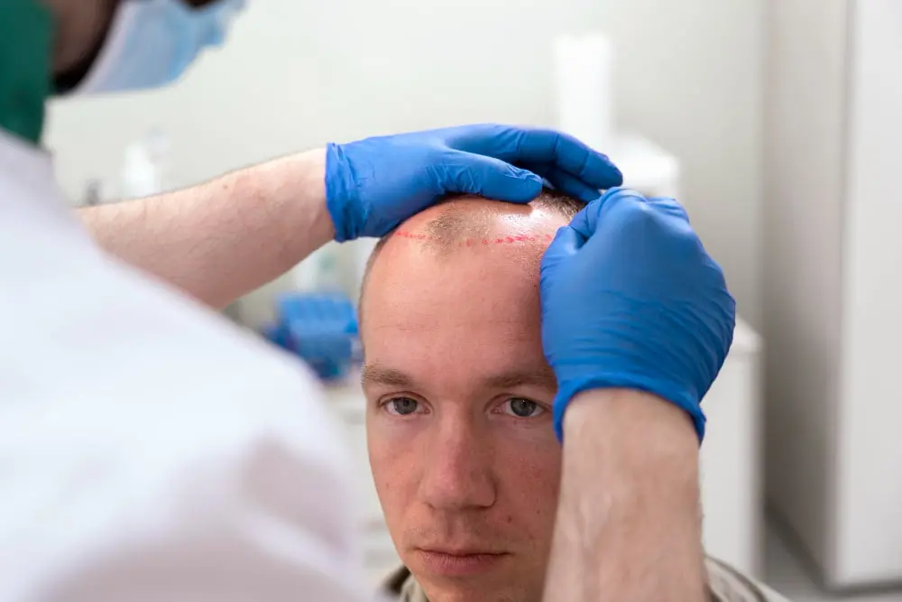 Planering av hårtransplantation.