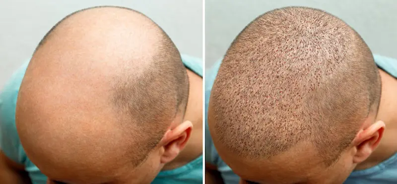 Resultat efter billigare hårtransplantation.
